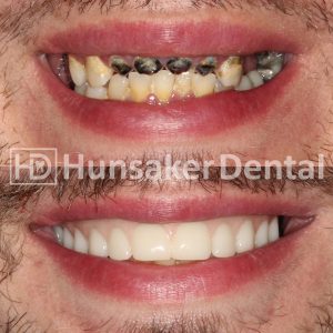 Full Mouth Dental Implants, Before and After