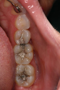 Fillings Local Family Dentistry in Salem OR