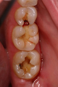 Fillings Local Family Dentistry in Salem OR
