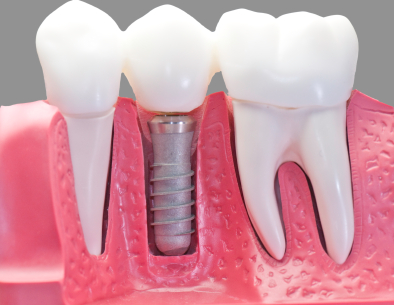 Capped dental implant Local Family Dentistry in Salem OR