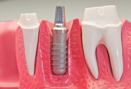 Dental implant Local Family Dentistry in Salem OR