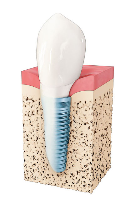 Local Family Dentistry in Salem OR