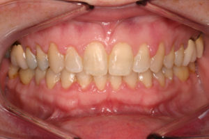 Invisalign Local Family Dentistry in Salem OR