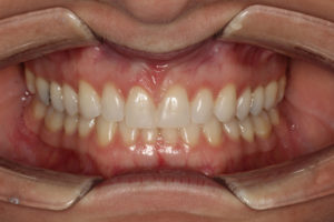Orthodontics with Salem Dentist Local Family Dentistry