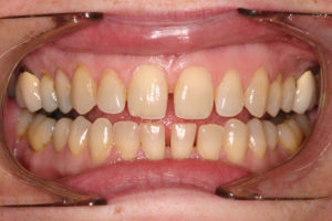 Invisalign Local Family Dentistry in Salem OR