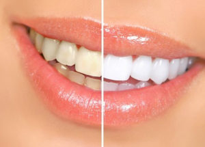 Local Family Dentistry in Salem OR