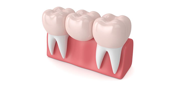 Dental Bridges Family Dentist in Salem Oregon