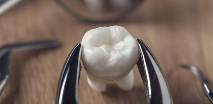Extraction Treatment Local Family Dentist in Salem Oregon