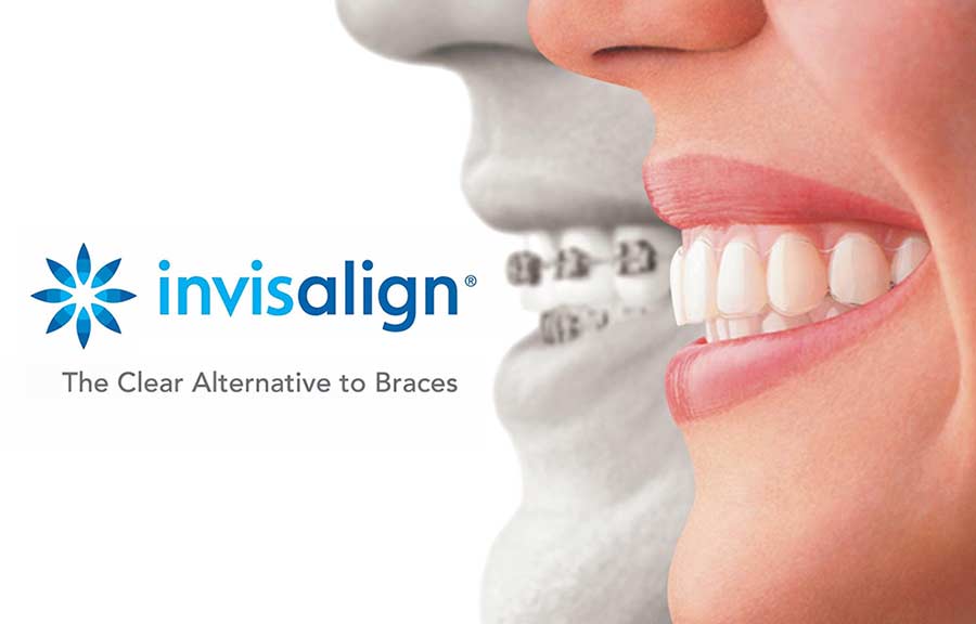 Straighten Teeth Using Invisalign in Salem OR
